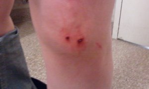 Escalator vs. Knee